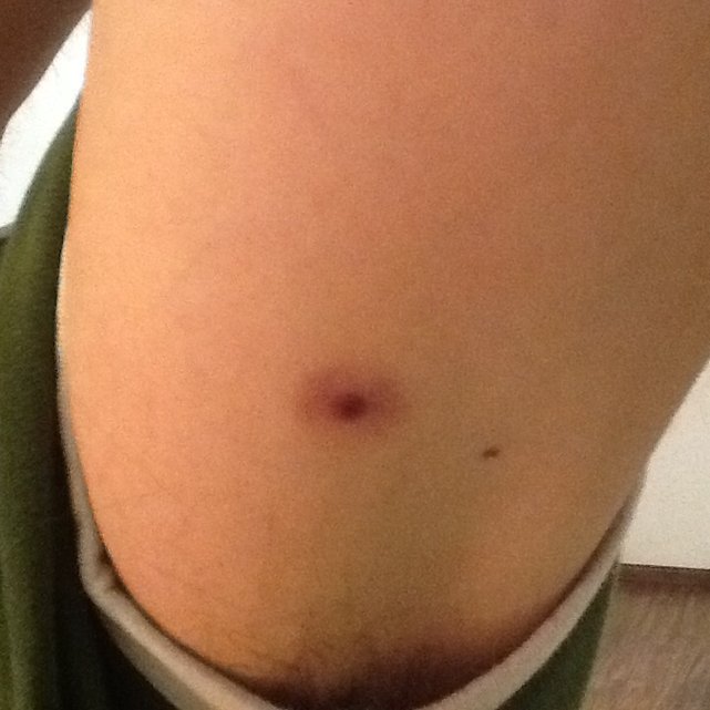 Ślad po przyssaniu pijawki. Singharaja Rainforest, Sri Lanka•Foto: D. Jaworska